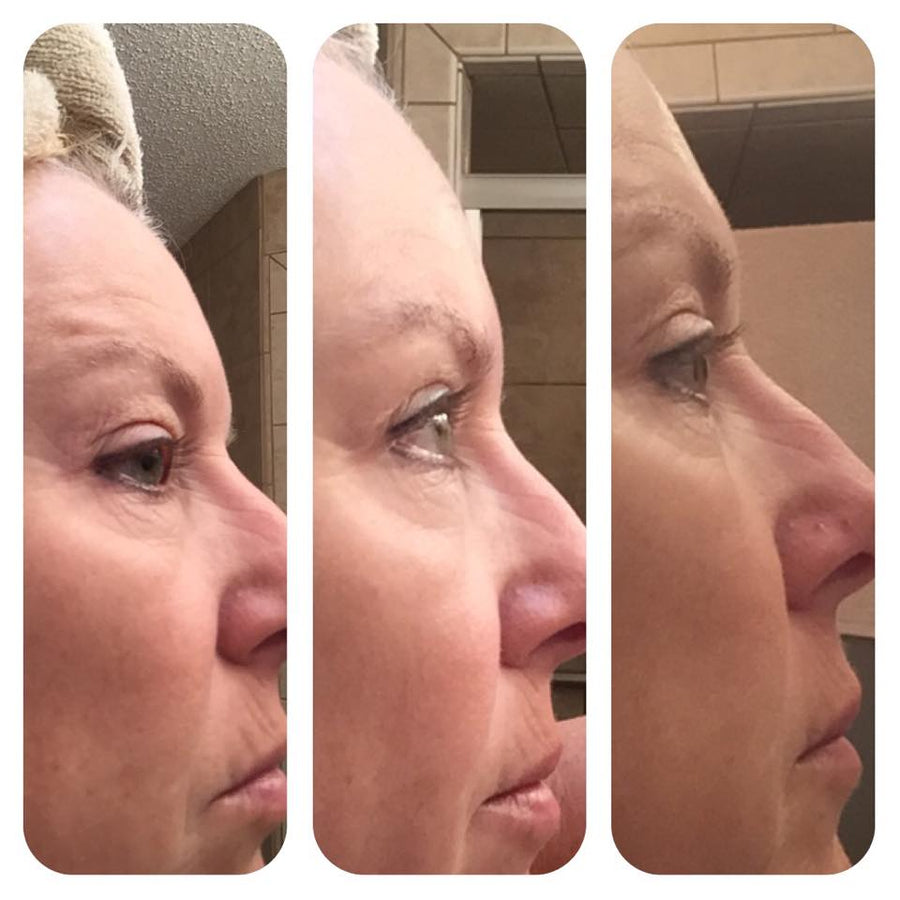 #Unfiltered Arg Spray Botox and Collagen Alternative